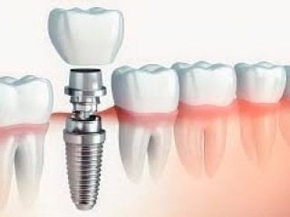 Dental Implants in Deesa