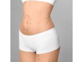 get-a-flatter-toned-abdomen-with-liposuction-360-in-maryland-aesthetic-lavcs-expert-care-small-0